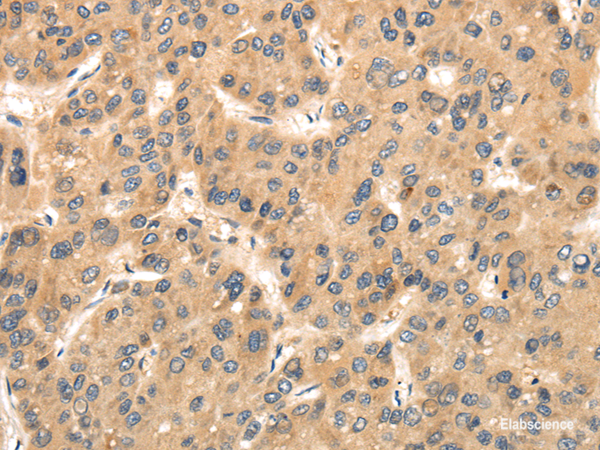 Immunohistochemistry of paraffin-embedded Human liver cancer using TTC23 Polyclonal Antibody at dilution of 1/35