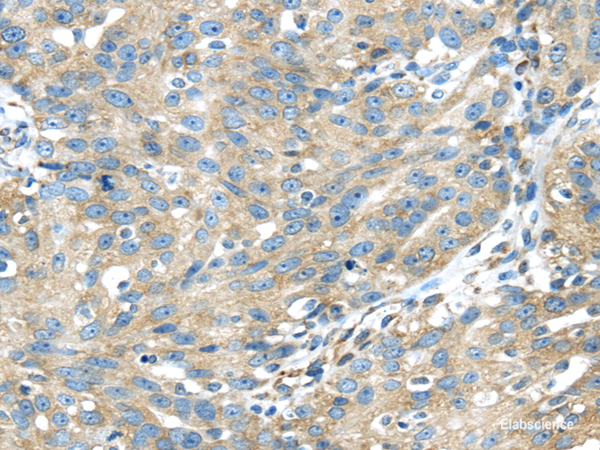 Immunohistochemistry of paraffin-embedded Human breast cancer using TXNDC5 Polyclonal Antibody at dilution of 1/40