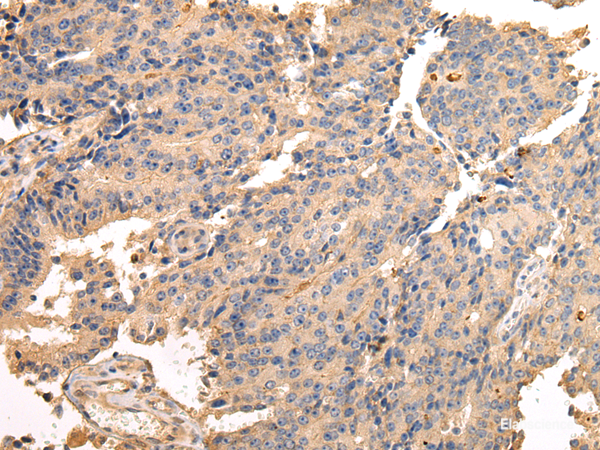 Immunohistochemistry of paraffin-embedded Human prostate cancer using SDCBP Polyclonal Antibody at dilution of 1/40