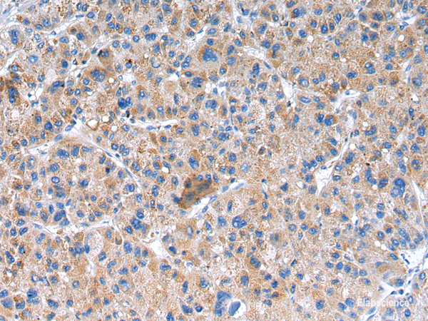 Immunohistochemistry of paraffin-embedded Human liver cancer using GLRA1 Polyclonal Antibody at dilution of 1/20