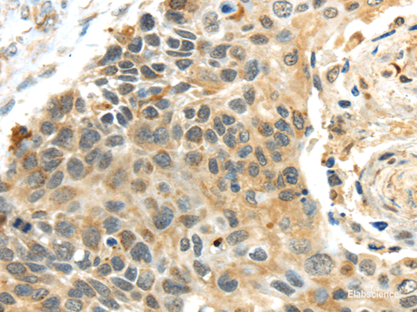 Immunohistochemistry of paraffin-embedded Human esophagus cancer using PROX1 Polyclonal Antibody at dilution of 1/40