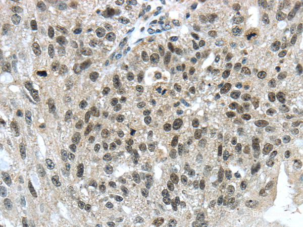 Immunohistochemistry of paraffin-embedded Human breast cancer using TRIM24 Polyclonal Antibody at dilution of 1/40