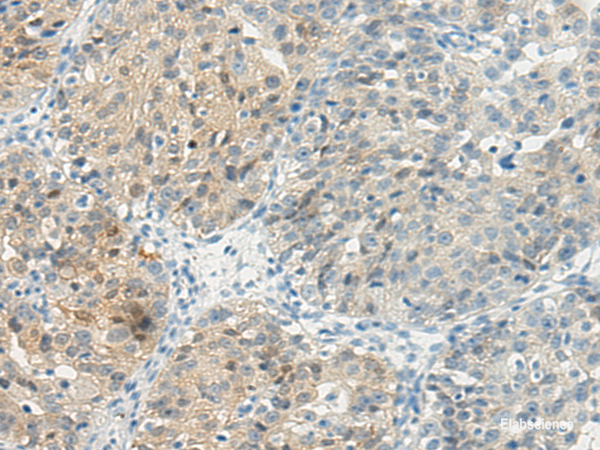 Immunohistochemistry of paraffin-embedded Human breast cancer tissue using TBXA2R Polyclonal Antibody at dilution 1:45