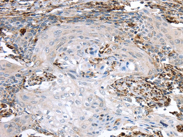 Immunohistochemistry of paraffin-embedded Human cervical cancer using TBXA2R Polyclonal Antibody at dilution of 1/40
