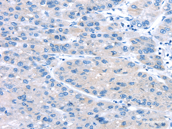 Immunohistochemistry of paraffin-embedded Human liver cancer using UCP2 Polyclonal Antibody at dilution of 1/20