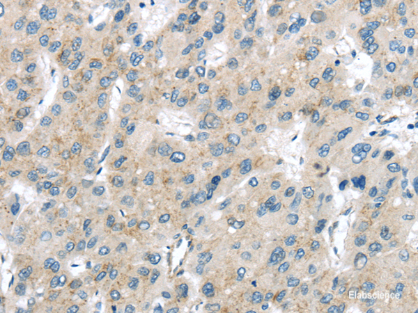 Immunohistochemistry of paraffin-embedded Human liver cancer using VPS26A Polyclonal Antibody at dilution of 1/40