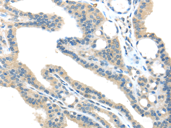 Immunohistochemistry of paraffin-embedded Human thyroid cancer tissue using VPS36 Polyclonal Antibody at dilution 1:40
