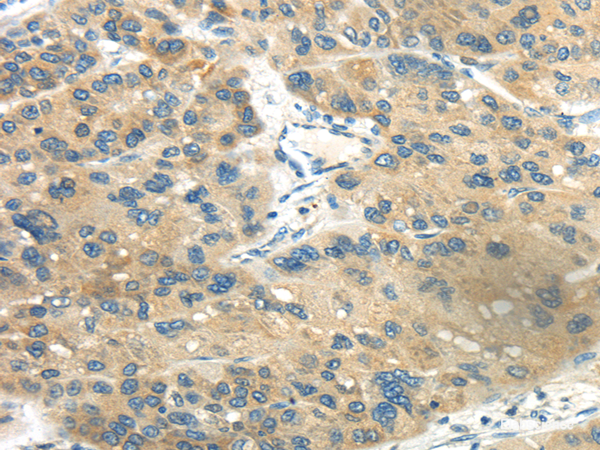 Immunohistochemistry of paraffin-embedded Human liver cancer tissue using CD70 Polyclonal Antibody at dilution 1:40