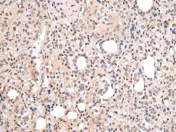Immunohistochemistry of paraffin-embedded Human thyroid cancer using CBX7 Polyclonal Antibody at dilution of 1/20
