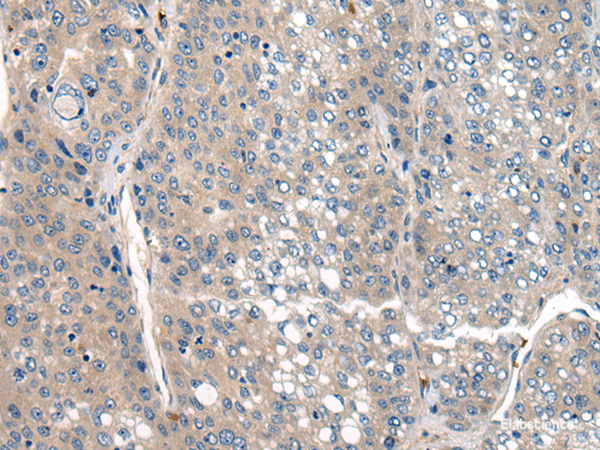 Immunohistochemistry of paraffin-embedded Human liver cancer tissue using CLTCL1 Polyclonal Antibody at dilution of 1:60(×200)
