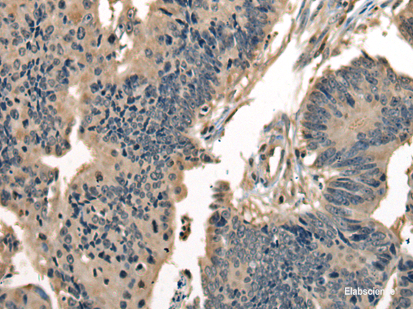 Immunohistochemistry of paraffin-embedded Human colorectal cancer tissue using DNAJC2 Polyclonal Antibody at dilution of 1:40(×200)