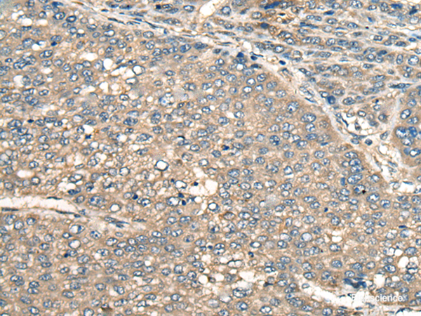 Immunohistochemistry of paraffin-embedded Human liver cancer tissue using PIAS3 Polyclonal Antibody at dilution of 1:55(×200)