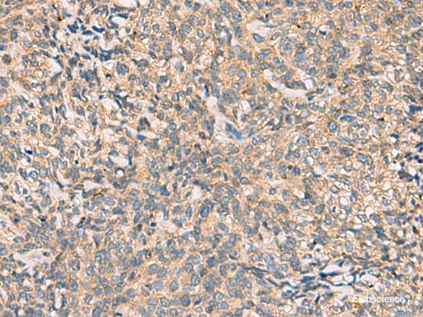 Immunohistochemistry of paraffin-embedded Human cervical cancer tissue using CMTM4 Polyclonal Antibody at dilution of 1:55(×200)