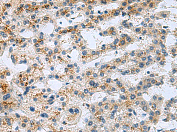 Immunohistochemistry of paraffin-embedded Human liver cancer tissue using GHRHR Polyclonal Antibody at dilution of 1:40(×200)