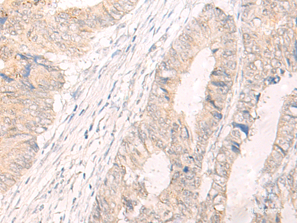 Immunohistochemistry of paraffin-embedded Human colorectal cancer tissue using IL33 Polyclonal Antibody at dilution of 1:25(×200)