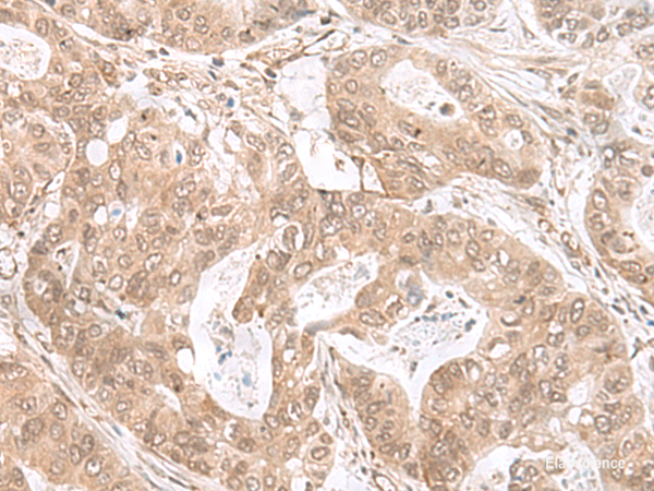 Immunohistochemistry of paraffin-embedded Human gastric cancer tissue using ETV3 Polyclonal Antibody at dilution of 1:25(×200)