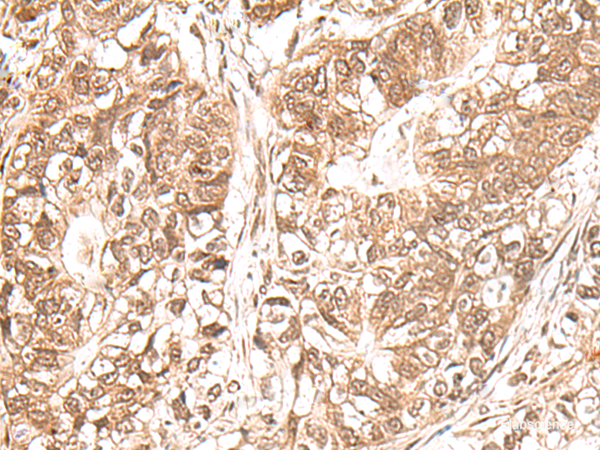 Immunohistochemistry of paraffin-embedded Human gastric cancer tissue using USP16 Polyclonal Antibody at dilution of 1:25(×200)