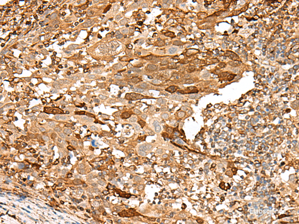 Immunohistochemistry of paraffin-embedded Human cervical cancer tissue using PIEZO2 Polyclonal Antibody at dilution of 1:55(×200)