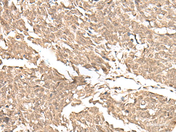 Immunohistochemistry of paraffin-embedded Human lung cancer tissue using KDM2A Polyclonal Antibody at dilution of 1:55(×200)