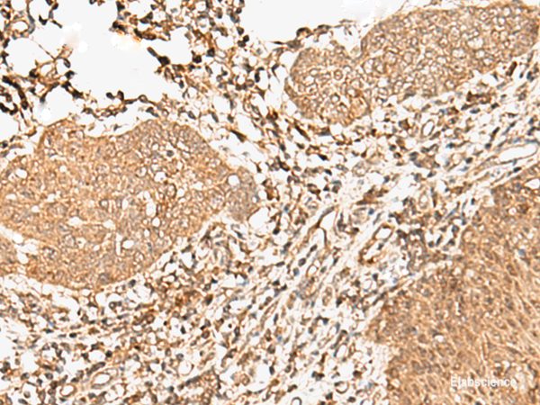 Immunohistochemistry of paraffin-embedded Human esophagus cancer tissue using FER Polyclonal Antibody at dilution of 1:90(×200)