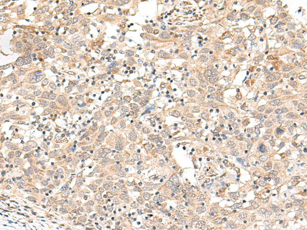 Immunohistochemistry of paraffin-embedded Human cervical cancer tissue using FUT3 Polyclonal Antibody at dilution of 1:35(×200)
