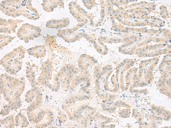Immunohistochemistry of paraffin-embedded Human thyroid cancer tissue using EPRS Polyclonal Antibody at dilution of 1:60(×200)