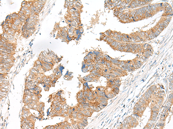 Immunohistochemistry of paraffin-embedded Human colorectal cancer tissue using SLC6A9 Polyclonal Antibody at dilution of 1:25(×200)