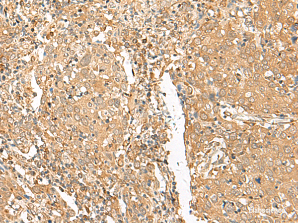 Immunohistochemistry of paraffin-embedded Human cervical cancer tissue using GOLGA6A Polyclonal Antibody at dilution of 1:50(×200)