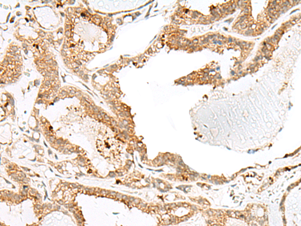 Immunohistochemistry of paraffin-embedded Human thyroid cancer tissue using ENAH Polyclonal Antibody at dilution of 1:60(×200)