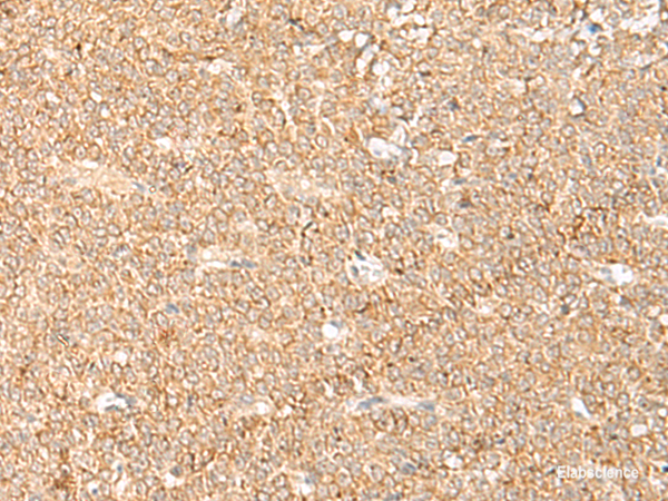 Immunohistochemistry of paraffin-embedded Human ovarian cancer tissue using LGALSL Polyclonal Antibody at dilution of 1:70(×200)