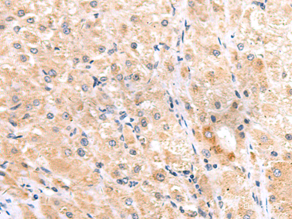 Immunohistochemistry of paraffin-embedded Human liver cancer tissue using ITGA3 Polyclonal Antibody at dilution of 1:45(×200)