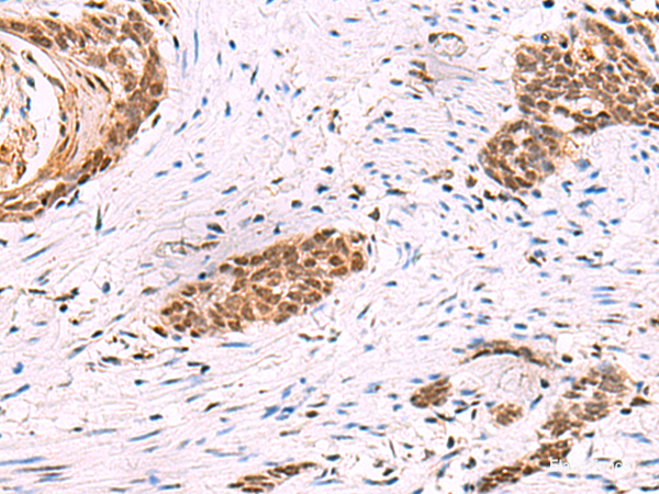 Immunohistochemistry of paraffin-embedded Human esophagus cancer tissue using CREBBP Polyclonal Antibody at dilution of 1:35(×200)