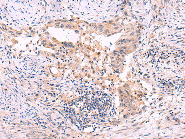 Immunohistochemistry of paraffin-embedded Human cervical cancer tissue using SLC12A5 Polyclonal Antibody at dilution of 1:40(×200)