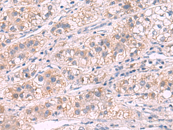 Immunohistochemistry of paraffin-embedded Human liver cancer tissue using G6PC Polyclonal Antibody at dilution of 1:50(×200)