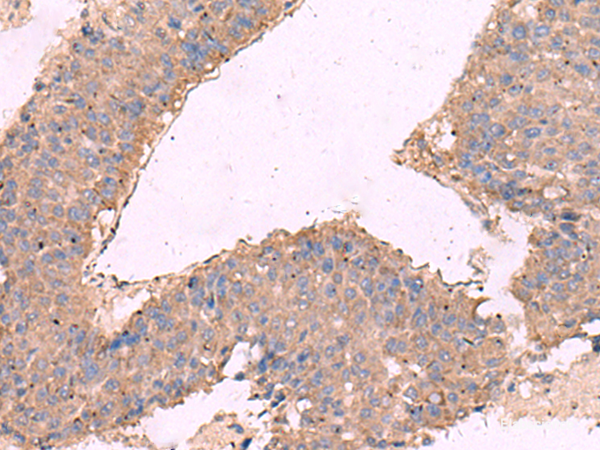 Immunohistochemistry of paraffin-embedded Human liver cancer tissue using KCNN3 Polyclonal Antibody at dilution of 1:40(×200)
