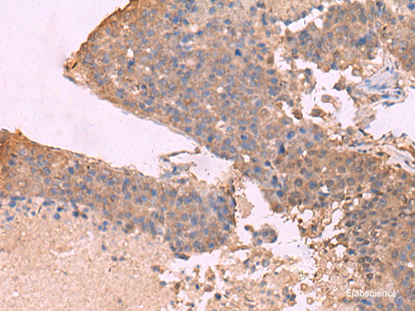 Immunohistochemistry of paraffin-embedded Human liver cancer tissue using KCNU1 Polyclonal Antibody at dilution of 1:45(×200)