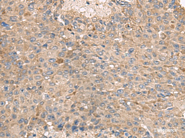 Immunohistochemistry of paraffin-embedded Human liver cancer tissue using ABCA10 Polyclonal Antibody at dilution of 1:50(×200)