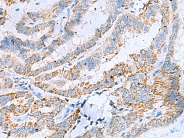 Immunohistochemistry of paraffin-embedded Human thyroid cancer tissue using KIF5A Polyclonal Antibody at dilution of 1:30(×200)