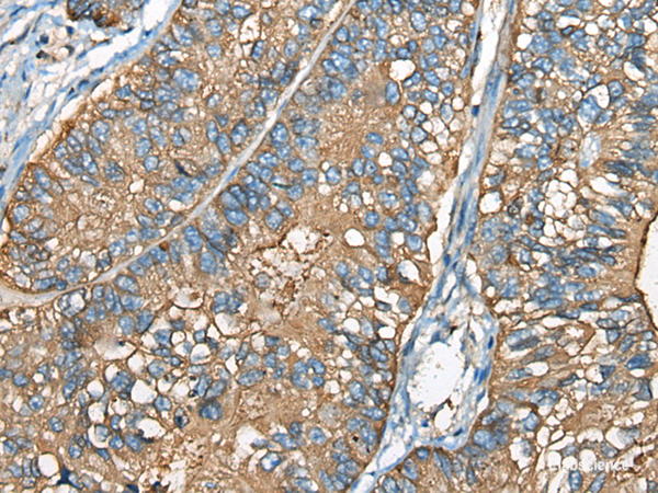Immunohistochemistry of paraffin-embedded Human gastric cancer tissue using CEACAM8 Polyclonal Antibody at dilution of 1:30(×200)