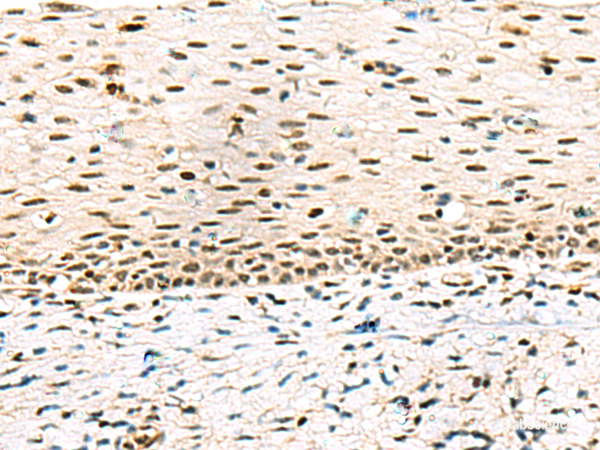 Immunohistochemistry of paraffin-embedded Human cervical cancer tissue using ABI2 Polyclonal Antibody at dilution of 1:45(×200)