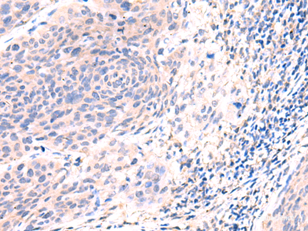 Immunohistochemistry of paraffin-embedded Human cervical cancer tissue using ESM1 Polyclonal Antibody at dilution of 1:50(×200)