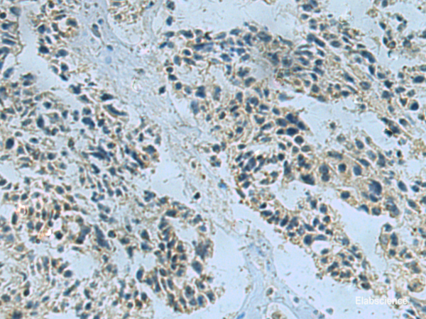 Immunohistochemistry of paraffin-embedded Human ovarian cancer tissue using NDUFA2 Polyclonal Antibody at dilution of 1:40(×200)