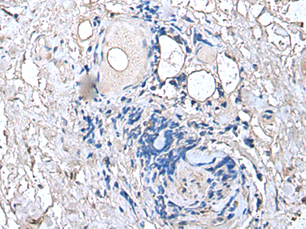 Immunohistochemistry of paraffin-embedded Human thyroid cancer tissue using PTP4A1 Polyclonal Antibody at dilution of 1:45(×200)