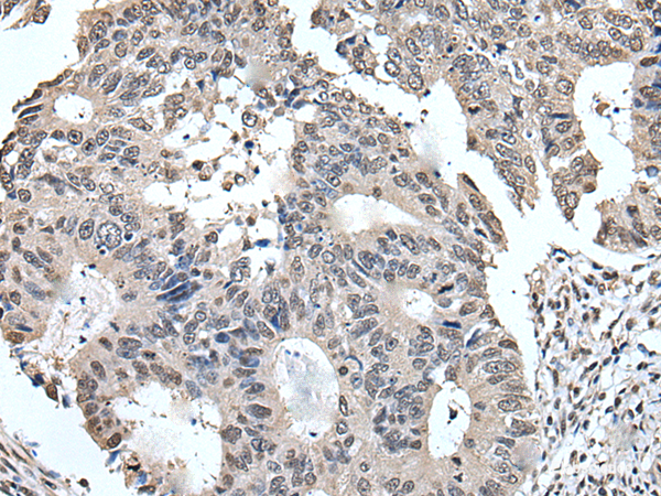 Immunohistochemistry of paraffin-embedded Human colorectal cancer tissue using TRIM23 Polyclonal Antibody at dilution of 1:55(×200)