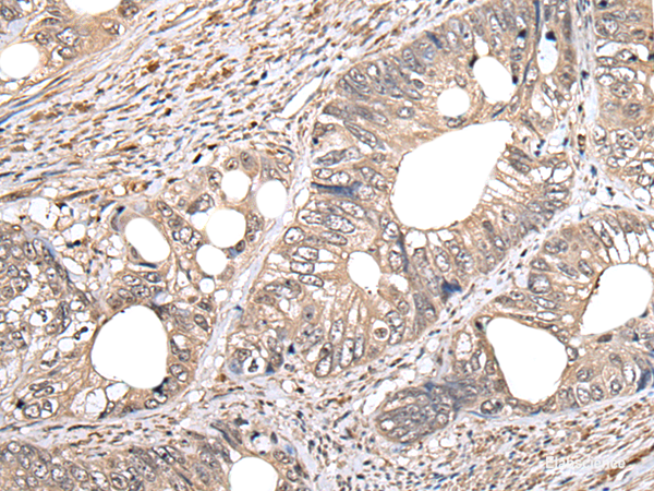 Immunohistochemistry of paraffin-embedded Human colorectal cancer tissue using GCNT2 Polyclonal Antibody at dilution of 1:60(×200)