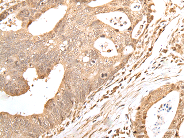 Immunohistochemistry of paraffin-embedded Human gastric cancer tissue using GRAP Polyclonal Antibody at dilution of 1:40(×200)