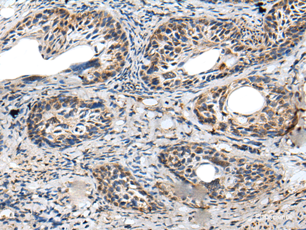 Immunohistochemistry of paraffin-embedded Human cervical cancer tissue using PRNP Polyclonal Antibody at dilution of 1:45(×200)