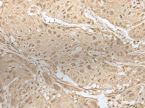 Immunohistochemistry of paraffin-embedded Human esophagus cancer tissue using ZBTB18 Polyclonal Antibody at dilution of 1:50(×200)