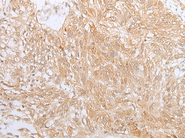 Immunohistochemistry of paraffin-embedded Human lung cancer tissue using ZNF34 Polyclonal Antibody at dilution of 1:40(×200)