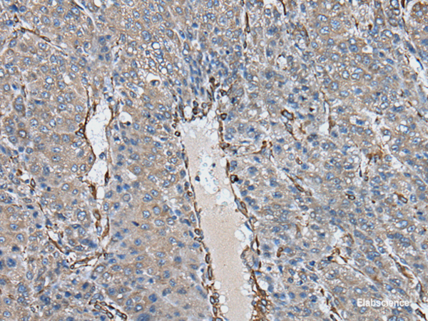 Immunohistochemistry of paraffin-embedded Human liver cancer tissue using USP25 Polyclonal Antibody at dilution of 1:40(×200)